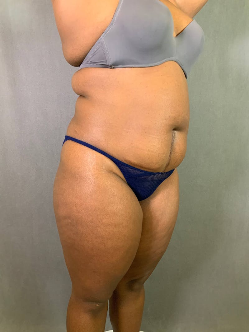 Standard Abdominoplasty Before & After Gallery - Patient 167403298 - Image 3