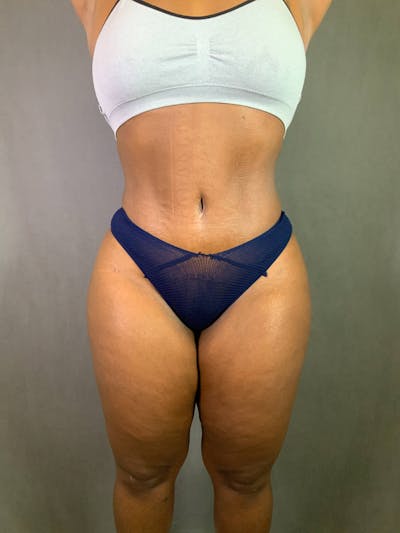 Standard Abdominoplasty Before & After Gallery - Patient 167403298 - Image 2
