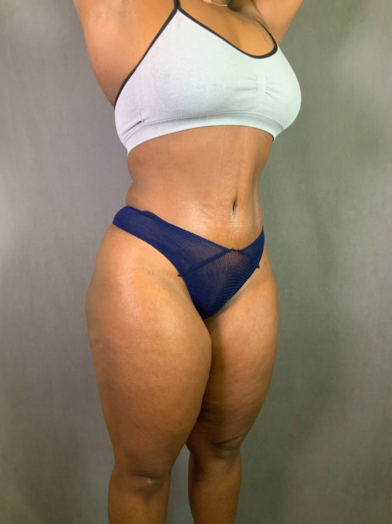 Standard Abdominoplasty Before & After Gallery - Patient 167403298 - Image 4