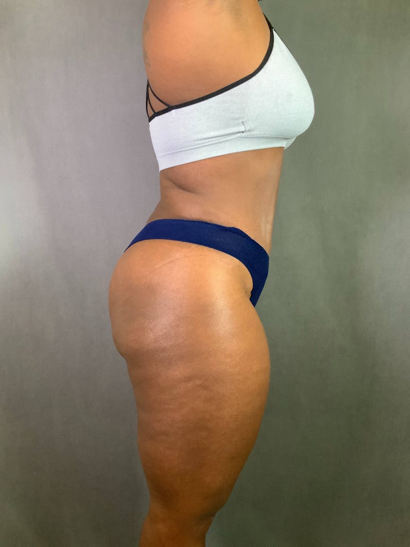 Standard Abdominoplasty Before & After Gallery - Patient 167403298 - Image 6