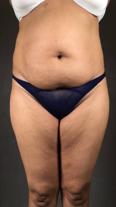 Standard Abdominoplasty Before & After Gallery - Patient 167403299 - Image 1