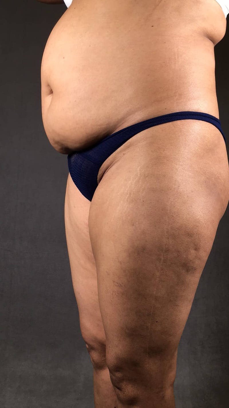 Standard Abdominoplasty Before & After Gallery - Patient 167403299 - Image 3