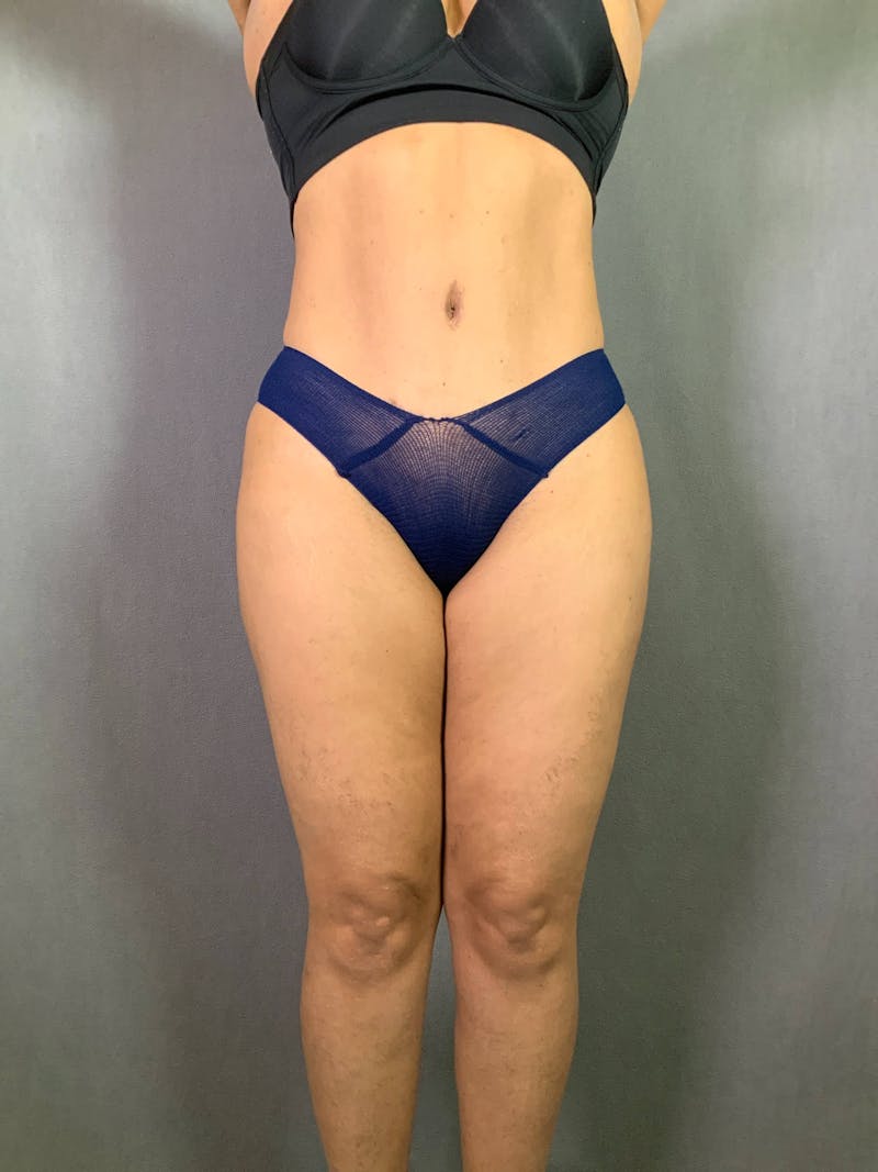 Standard Abdominoplasty Before & After Gallery - Patient 167403299 - Image 2