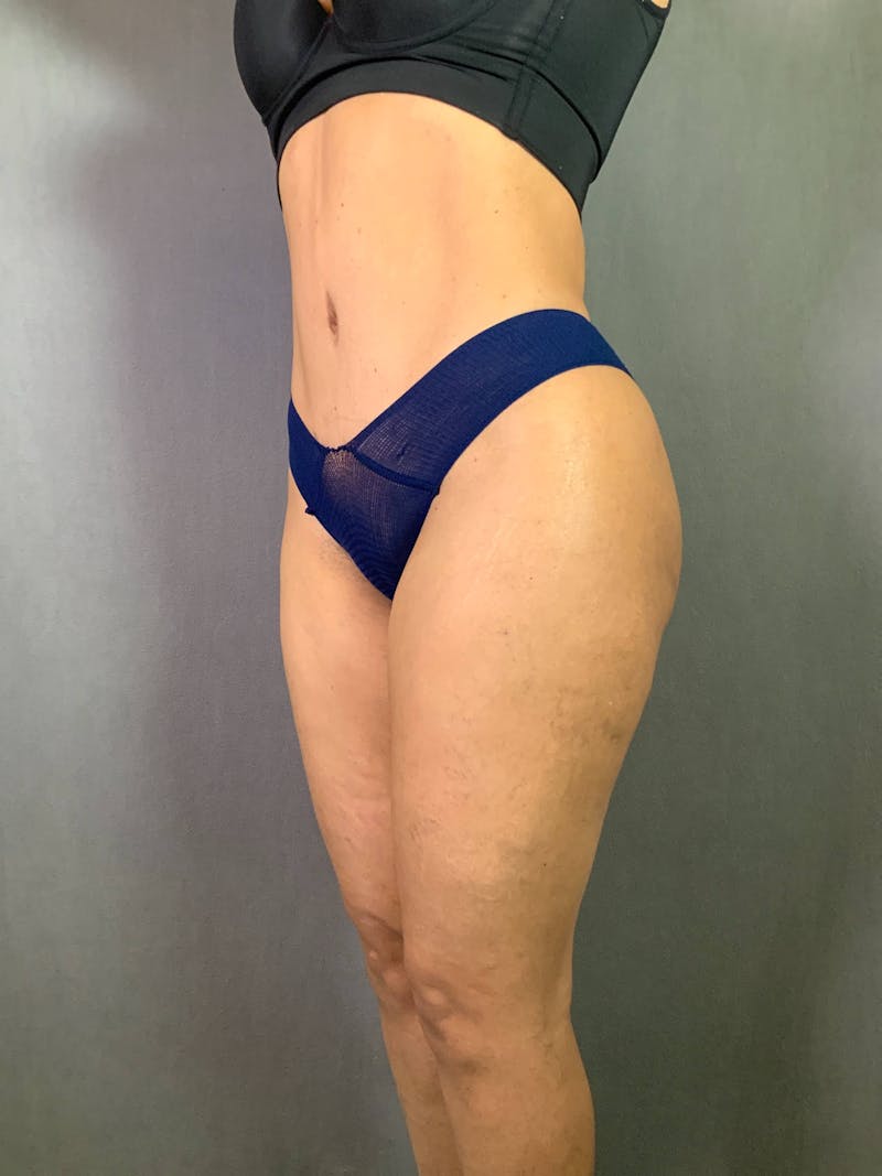 Standard Abdominoplasty Before & After Gallery - Patient 167403299 - Image 4