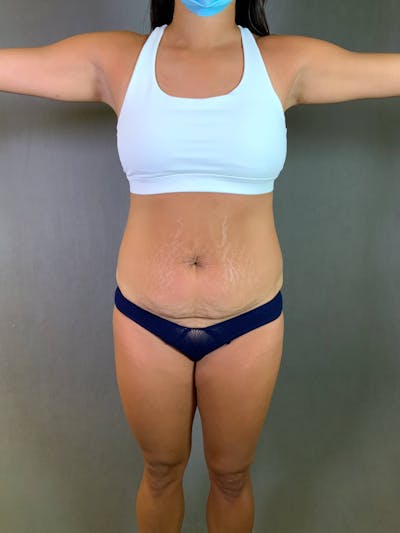 Standard Abdominoplasty Before & After Gallery - Patient 167403300 - Image 1