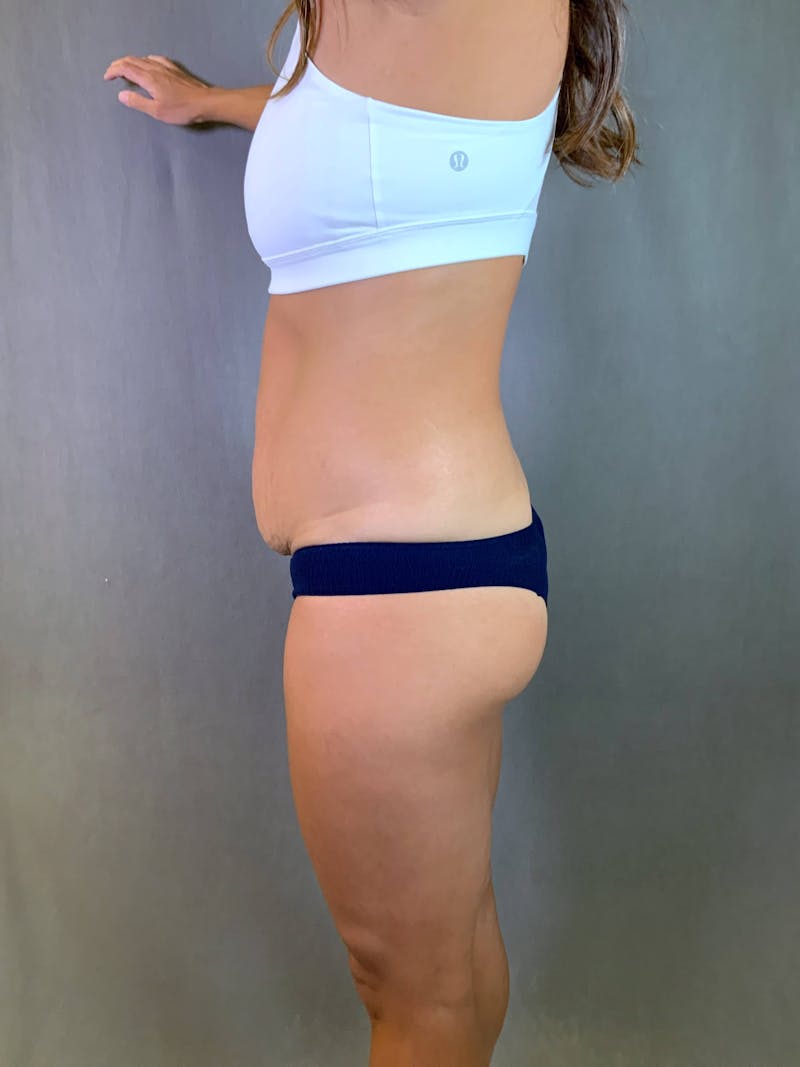 Standard Abdominoplasty Before & After Gallery - Patient 167403300 - Image 3