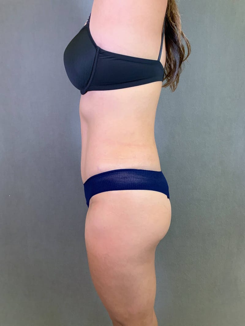 Standard Abdominoplasty Before & After Gallery - Patient 167403300 - Image 4
