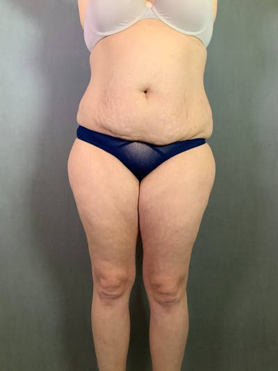 Standard Abdominoplasty Before & After Gallery - Patient 167403301 - Image 1