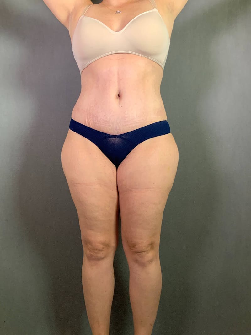 Standard Abdominoplasty Before & After Gallery - Patient 167403301 - Image 2
