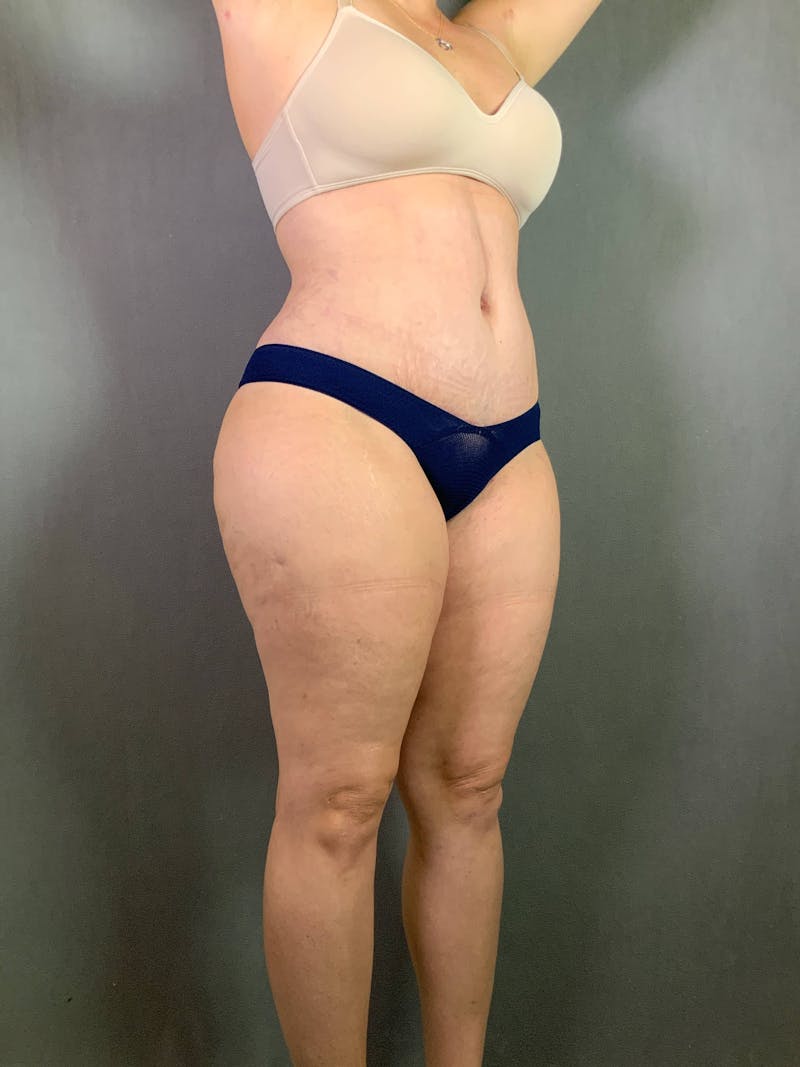 Standard Abdominoplasty Before & After Gallery - Patient 167403301 - Image 4