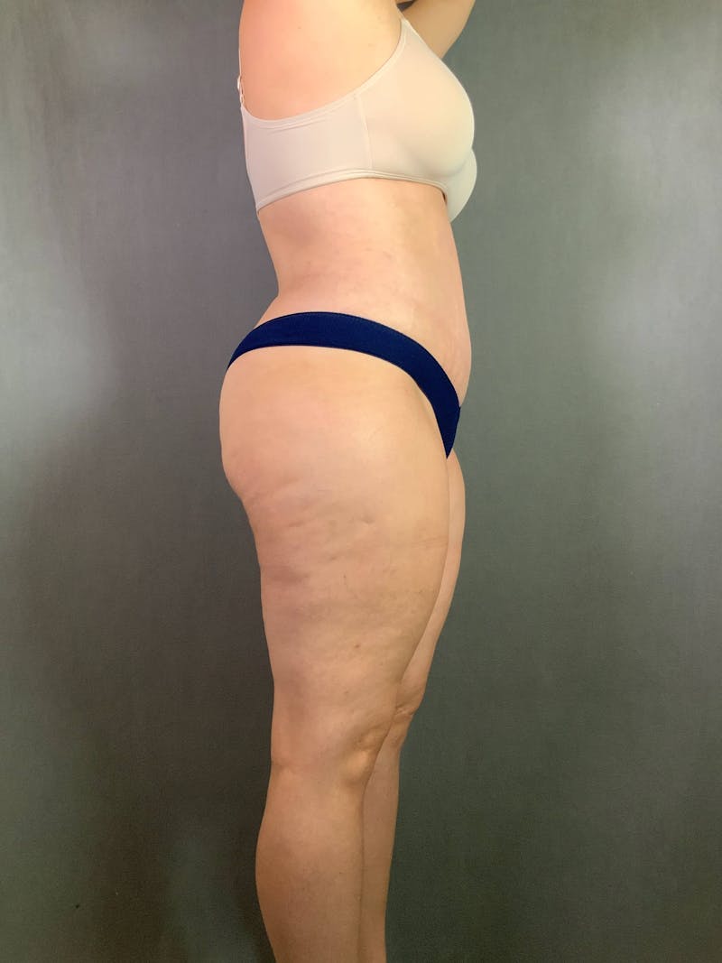Standard Abdominoplasty Before & After Gallery - Patient 167403301 - Image 6