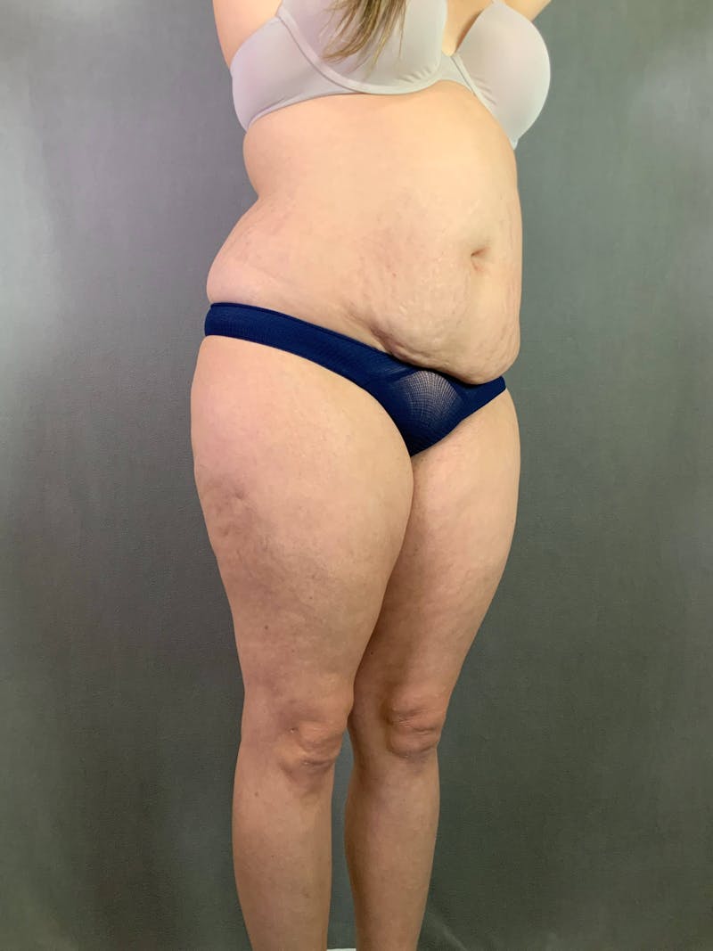 Standard Abdominoplasty Before & After Gallery - Patient 167403301 - Image 3
