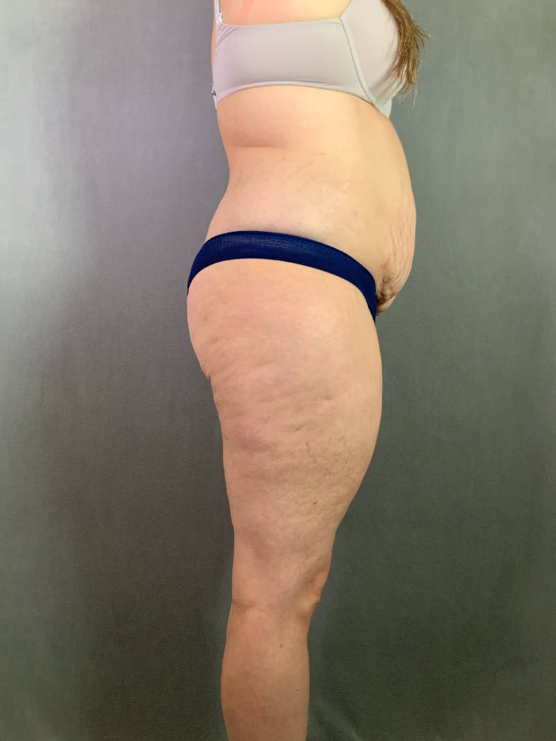 Standard Abdominoplasty Before & After Gallery - Patient 167403301 - Image 5