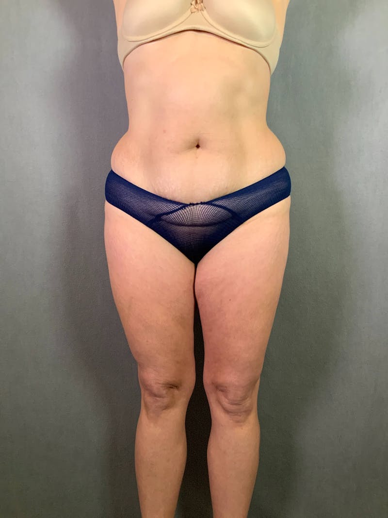 Standard Abdominoplasty Before & After Gallery - Patient 167403305 - Image 1