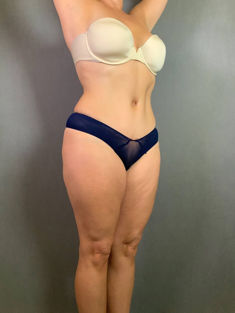 Standard Abdominoplasty Before & After Gallery - Patient 167403305 - Image 4