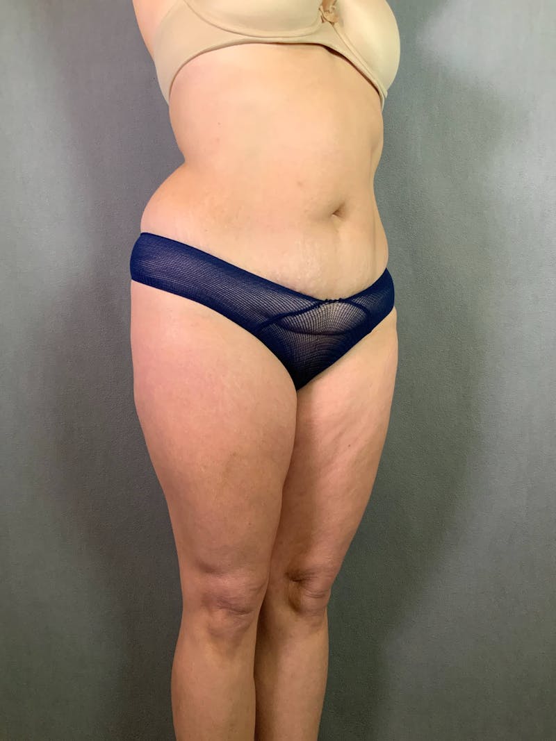 Standard Abdominoplasty Before & After Gallery - Patient 167403305 - Image 3