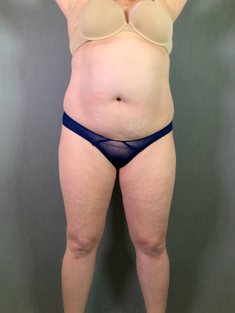 Standard Abdominoplasty Before & After Gallery - Patient 167403306 - Image 1
