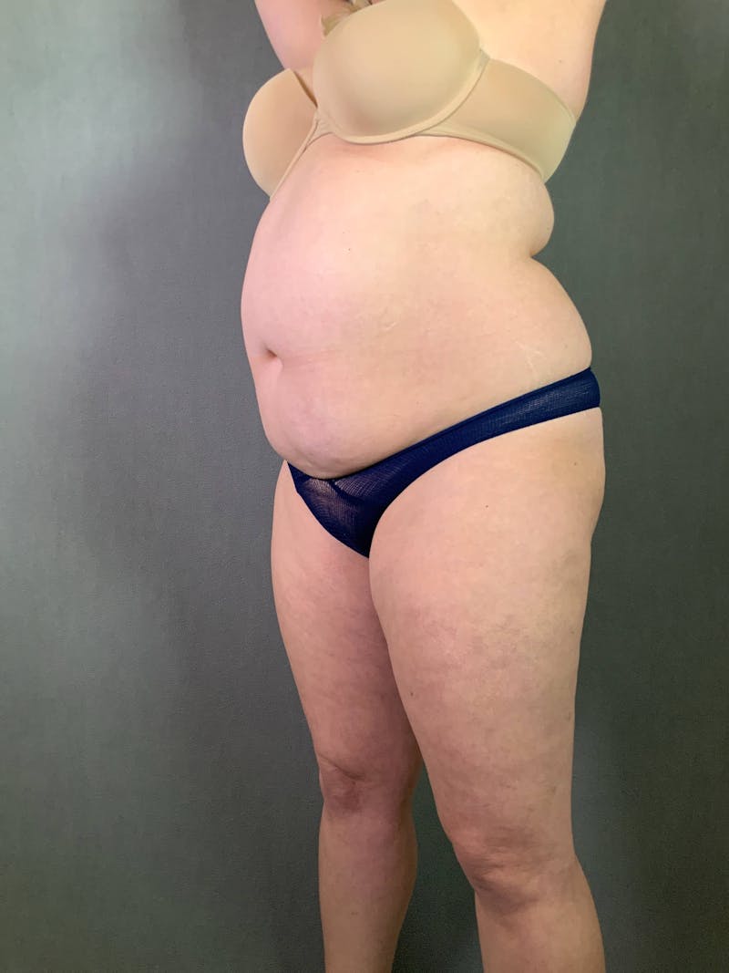 Standard Abdominoplasty Before & After Gallery - Patient 167403306 - Image 3