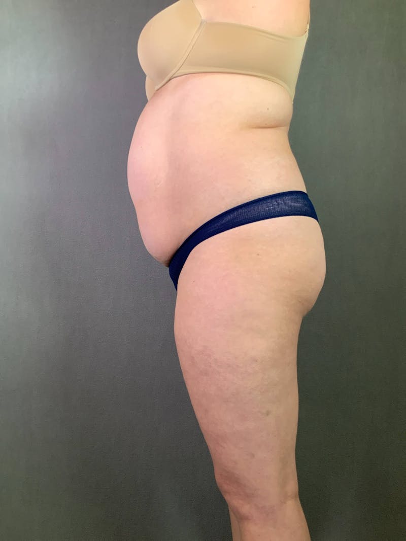 Standard Abdominoplasty Before & After Gallery - Patient 167403306 - Image 5