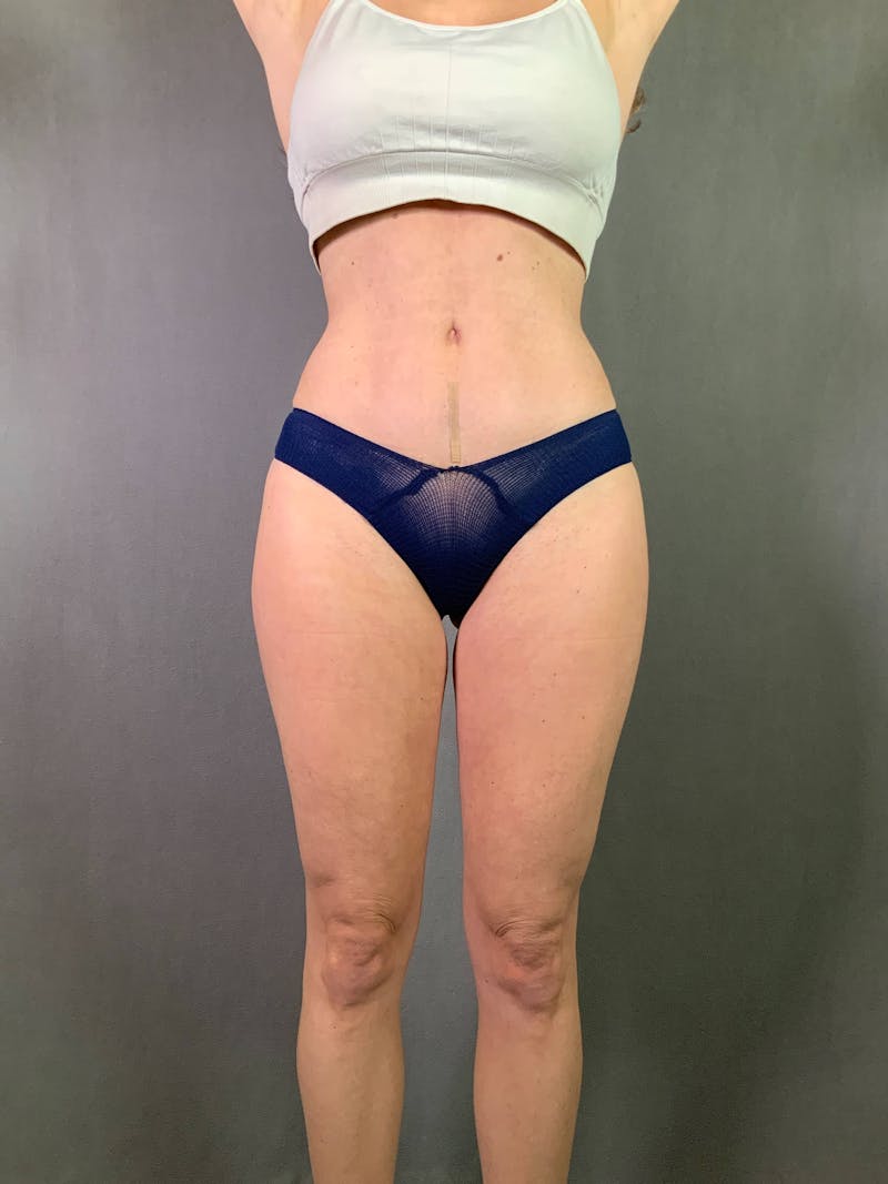 Standard Abdominoplasty Before & After Gallery - Patient 167403308 - Image 2