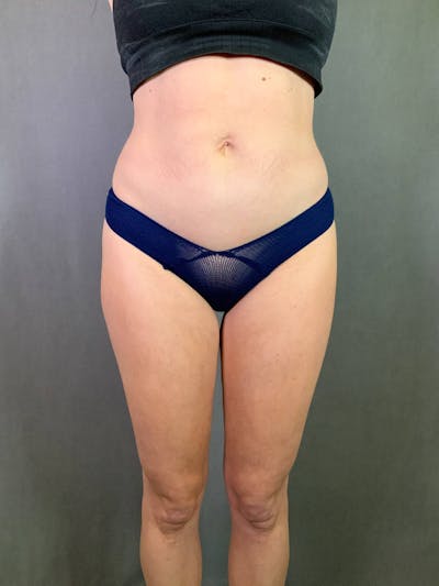 Standard Abdominoplasty Before & After Gallery - Patient 167403308 - Image 1