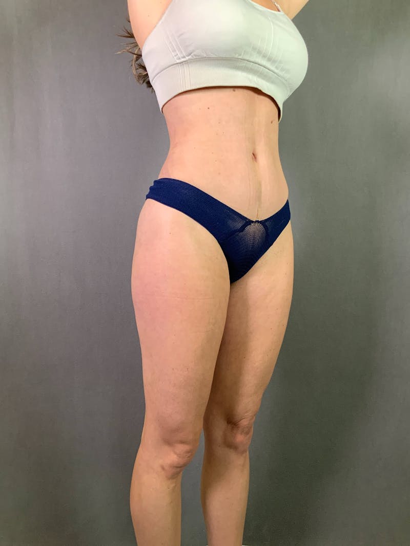 Standard Abdominoplasty Before & After Gallery - Patient 167403308 - Image 4