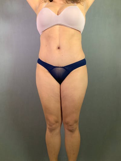 Standard Abdominoplasty Before & After Gallery - Patient 167403313 - Image 2