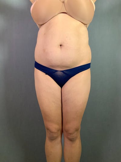 Standard Abdominoplasty Before & After Gallery - Patient 167403313 - Image 1