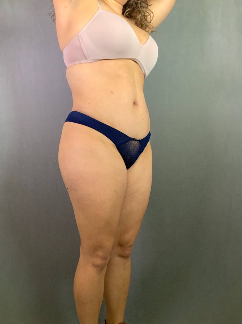 Standard Abdominoplasty Before & After Gallery - Patient 167403313 - Image 4