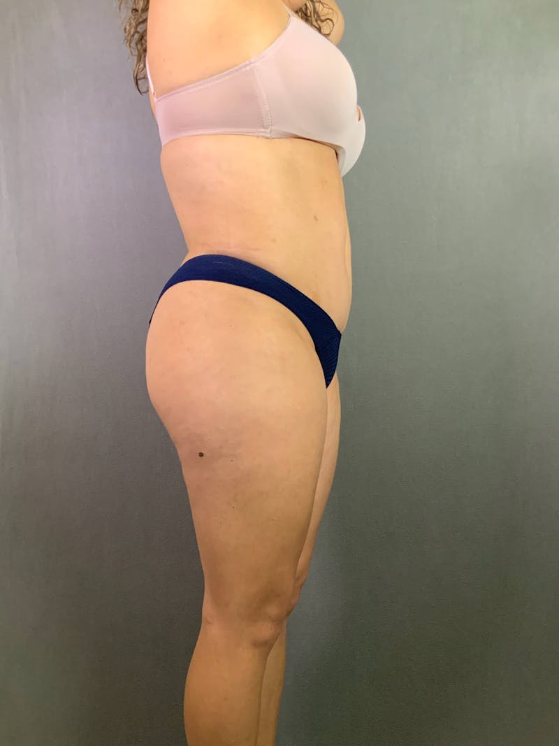 Standard Abdominoplasty Before & After Gallery - Patient 167403313 - Image 6