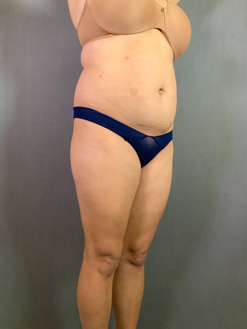 Standard Abdominoplasty Before & After Gallery - Patient 167403313 - Image 3