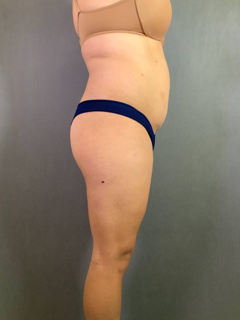 Standard Abdominoplasty Before & After Gallery - Patient 167403313 - Image 5
