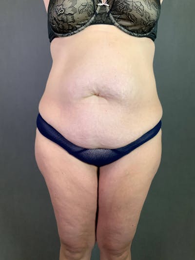 Standard Abdominoplasty Before & After Gallery - Patient 167403315 - Image 1