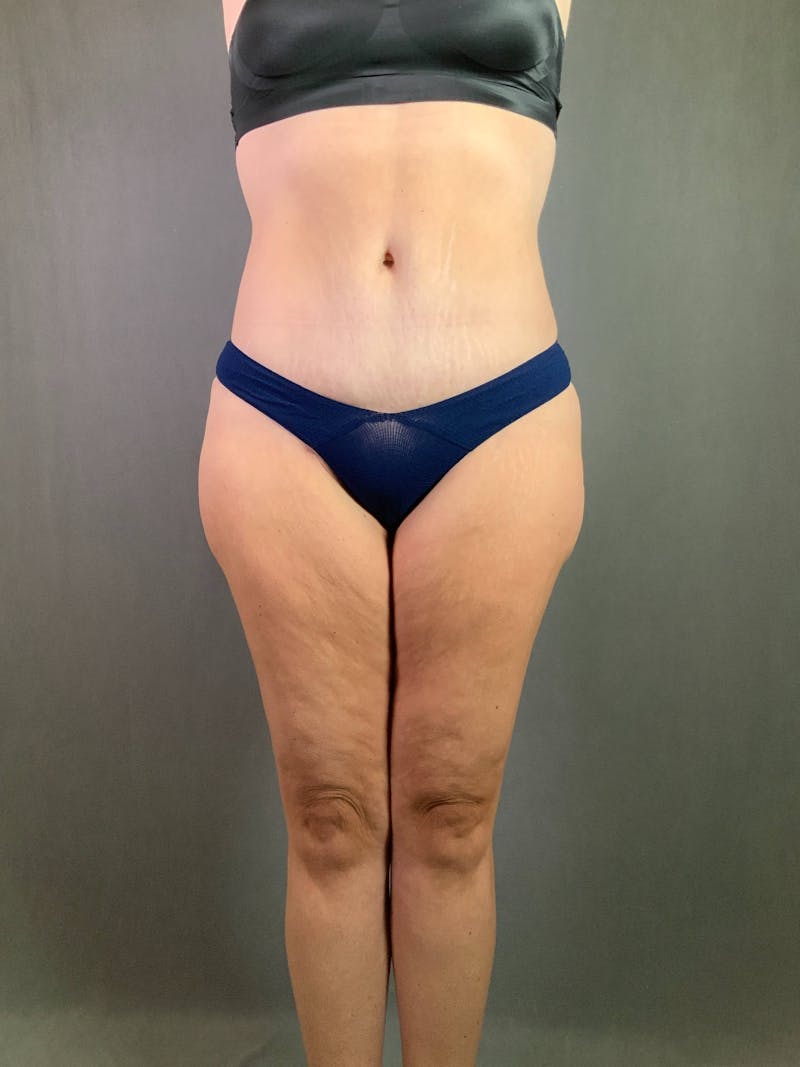 Standard Abdominoplasty Before & After Gallery - Patient 167403315 - Image 2