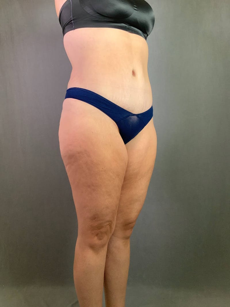 Standard Abdominoplasty Before & After Gallery - Patient 167403315 - Image 4