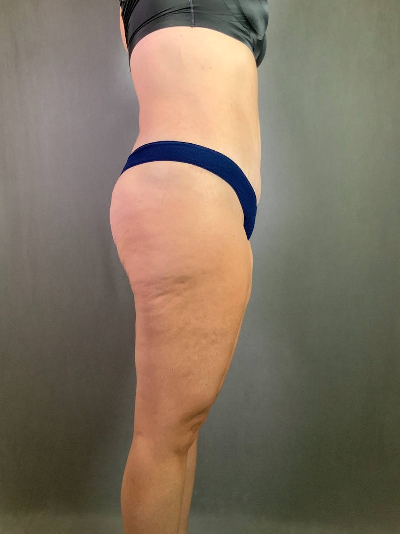 Standard Abdominoplasty Before & After Gallery - Patient 167403315 - Image 6