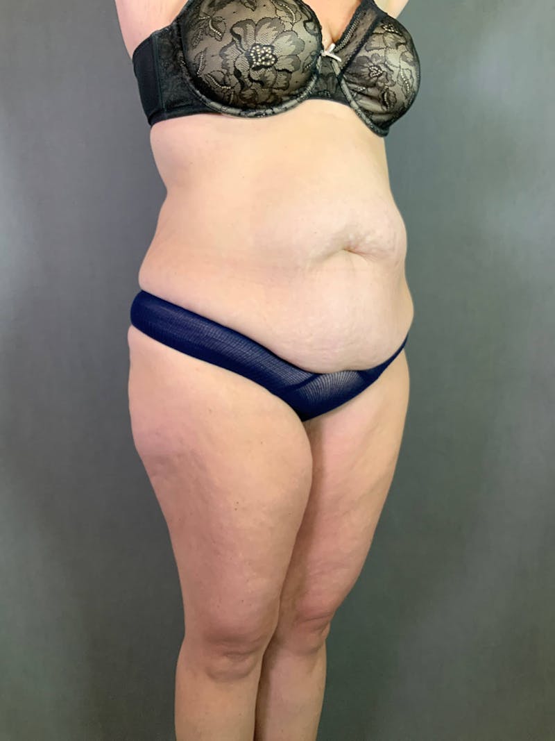 Standard Abdominoplasty Before & After Gallery - Patient 167403315 - Image 3