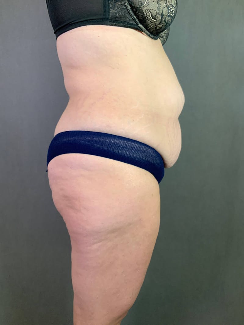 Standard Abdominoplasty Before & After Gallery - Patient 167403315 - Image 5
