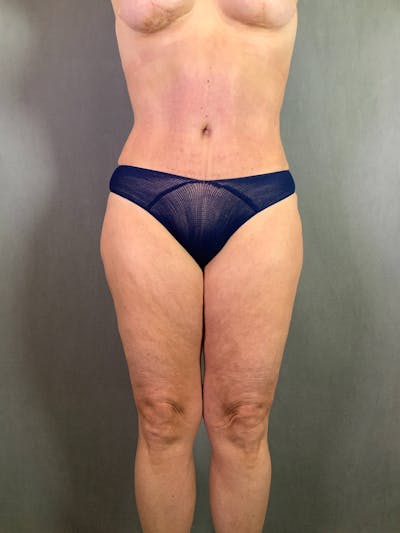 Standard Abdominoplasty Before & After Gallery - Patient 167403324 - Image 2