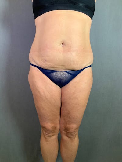 Standard Abdominoplasty Before & After Gallery - Patient 167403324 - Image 1