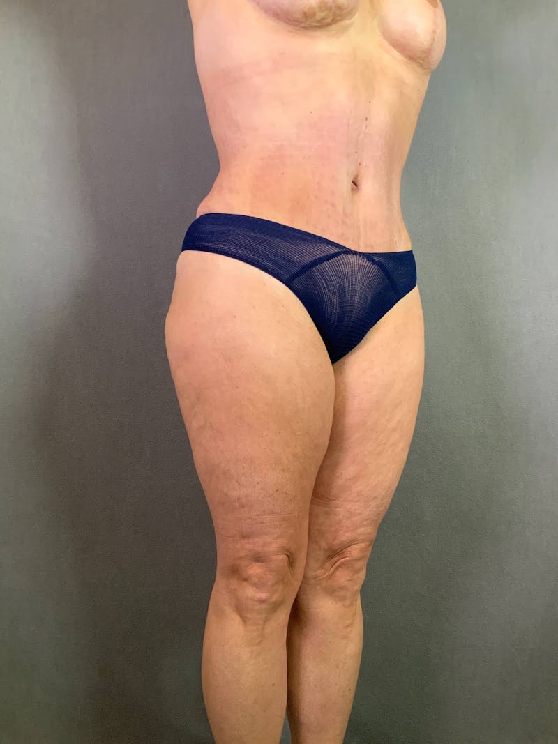 Standard Abdominoplasty Before & After Gallery - Patient 167403324 - Image 3