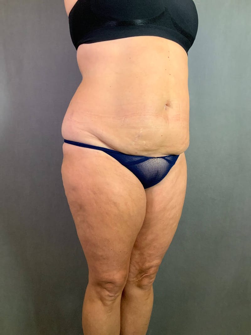 Standard Abdominoplasty Before & After Gallery - Patient 167403324 - Image 4
