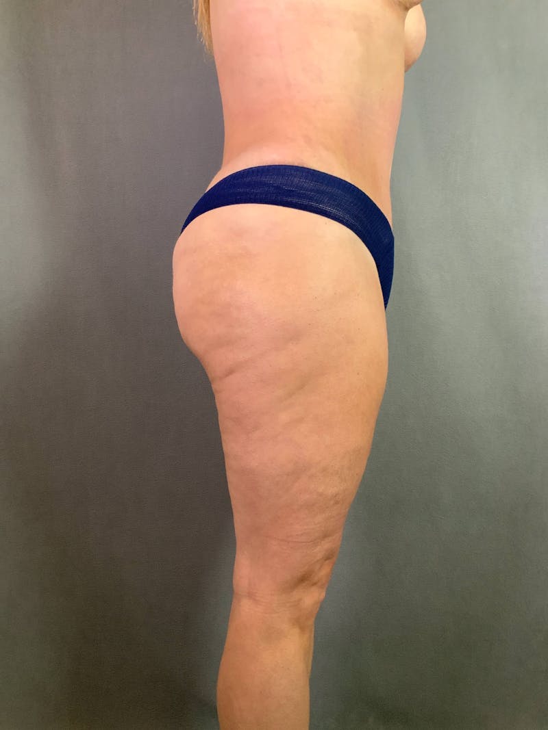 Standard Abdominoplasty Before & After Gallery - Patient 167403324 - Image 5