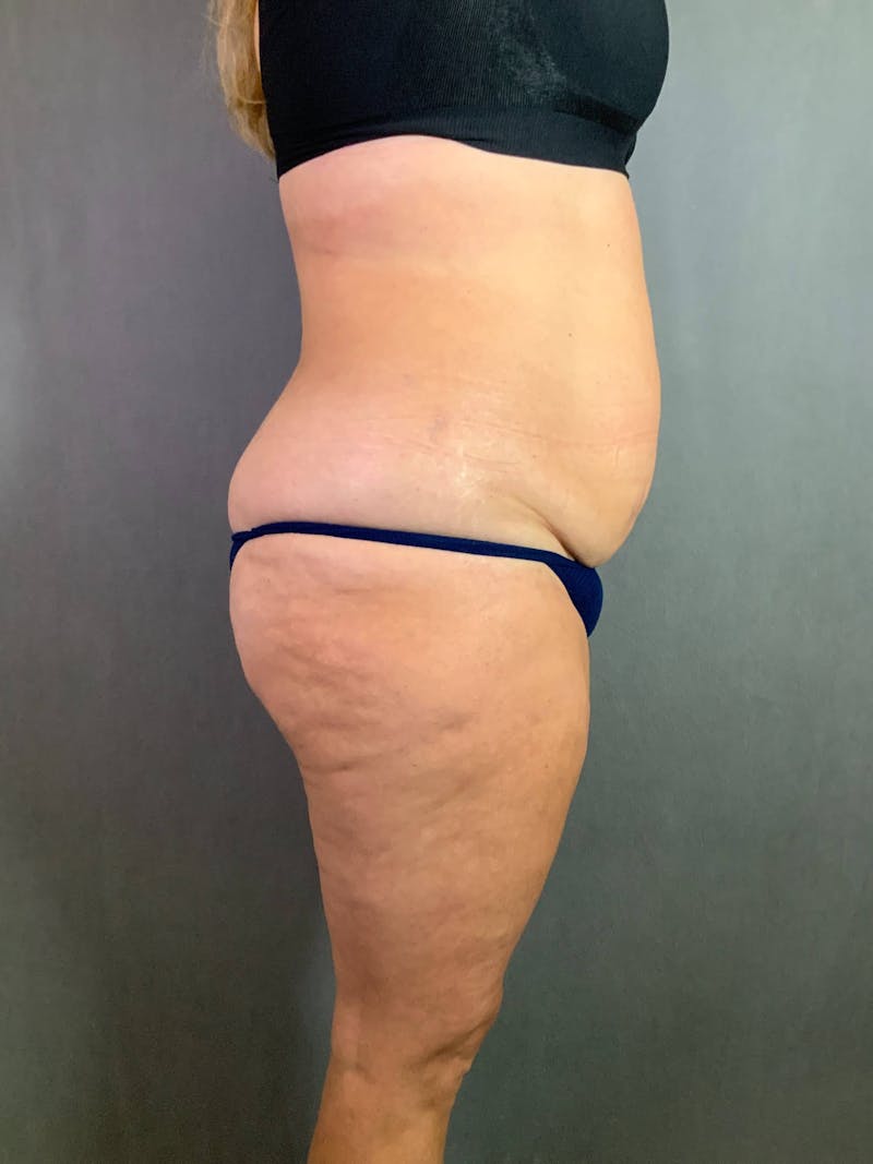 Standard Abdominoplasty Before & After Gallery - Patient 167403324 - Image 6