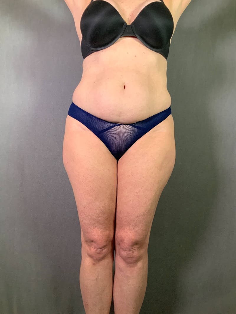 Standard Abdominoplasty Before & After Gallery - Patient 167403325 - Image 1