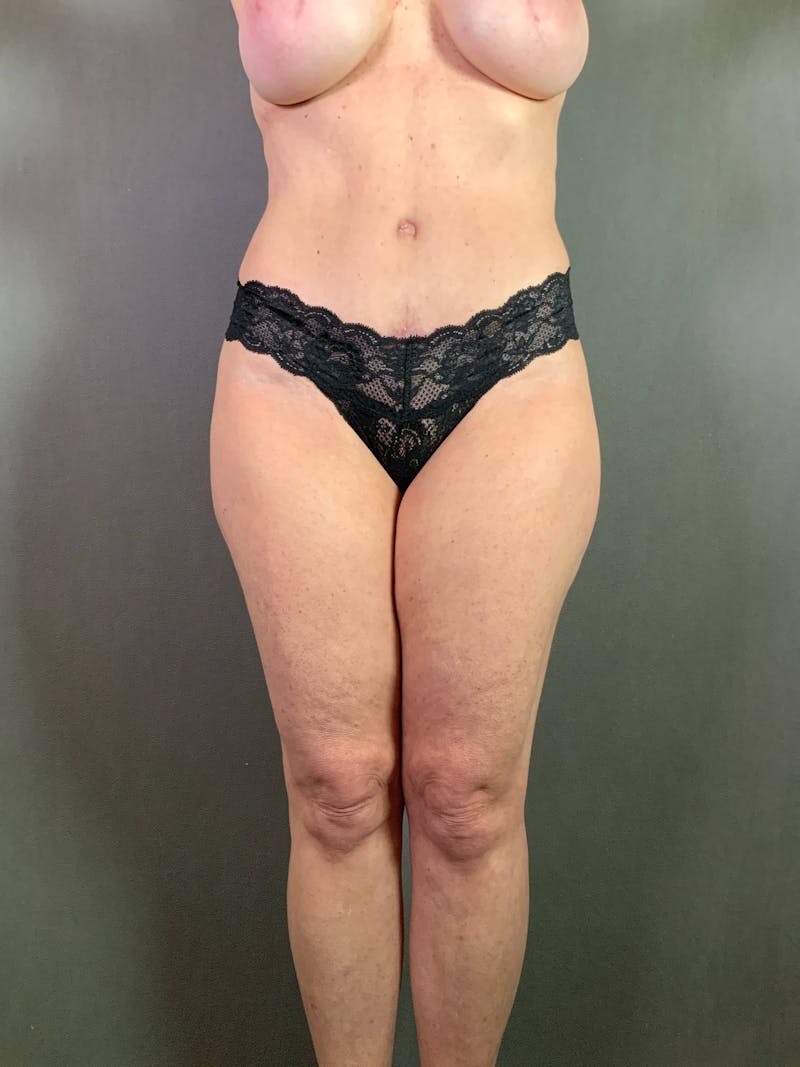 Standard Abdominoplasty Before & After Gallery - Patient 167403325 - Image 2