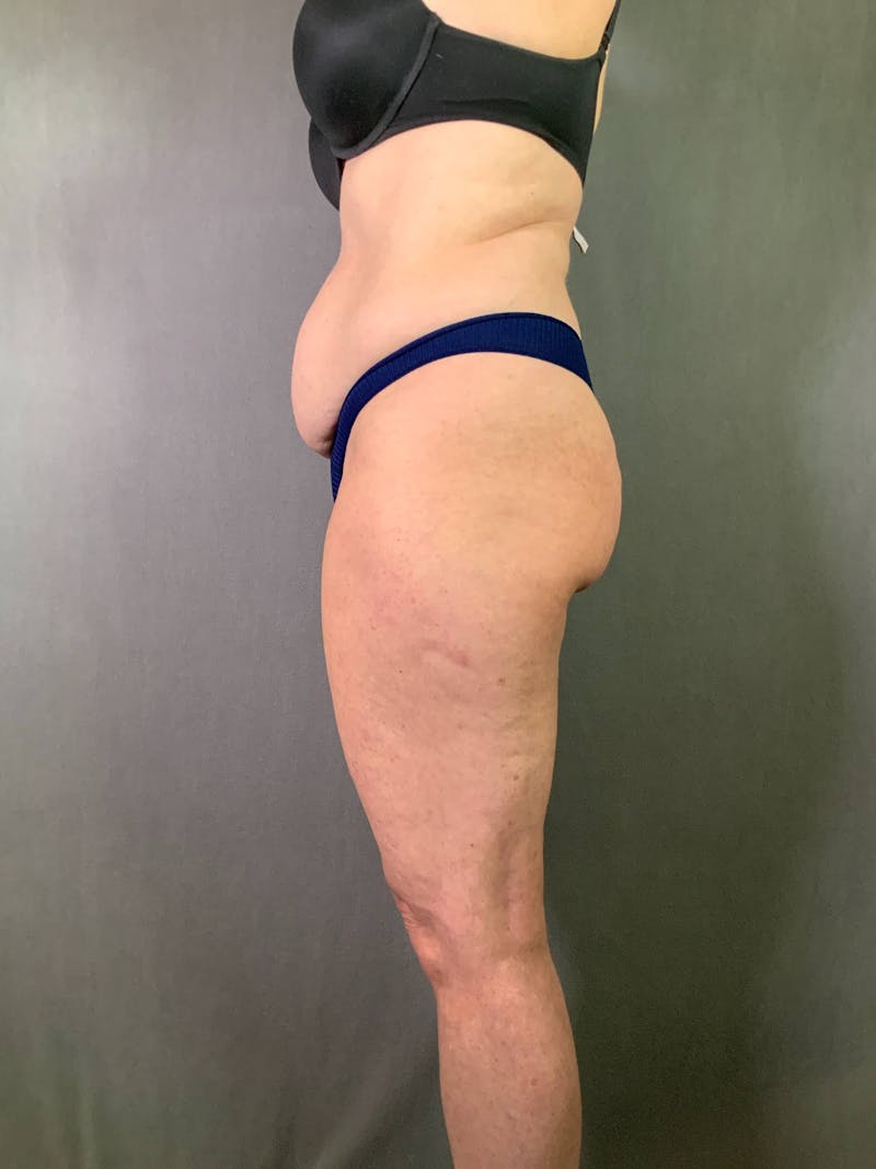 Standard Abdominoplasty Before & After Gallery - Patient 167403325 - Image 7