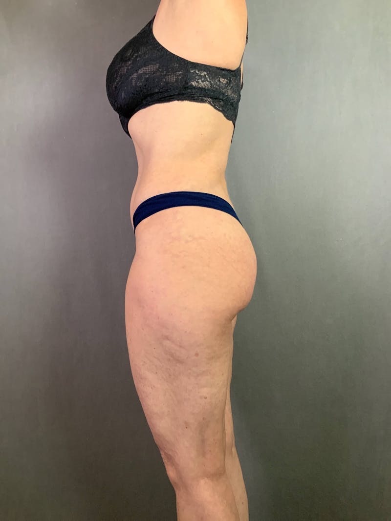 Standard Abdominoplasty Before & After Gallery - Patient 167403325 - Image 8