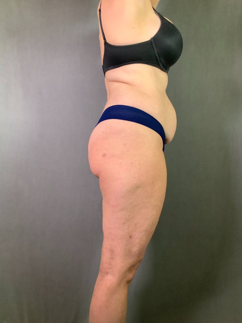 Standard Abdominoplasty Before & After Gallery - Patient 167403325 - Image 3