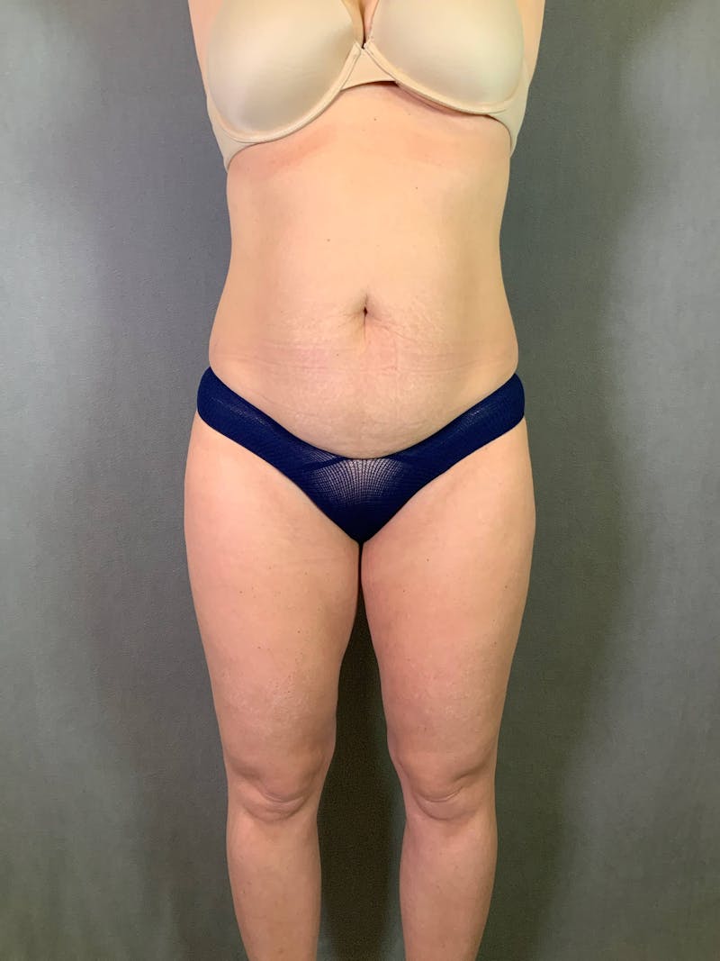 Standard Abdominoplasty Before & After Gallery - Patient 167403350 - Image 1